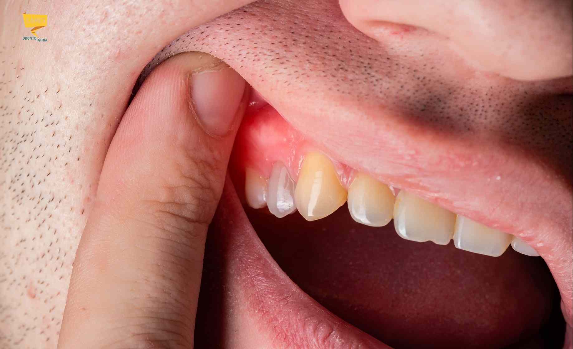 gengive gonfie e infiammate con arrossamento e segni di infiammazione gengive vicino ai denti