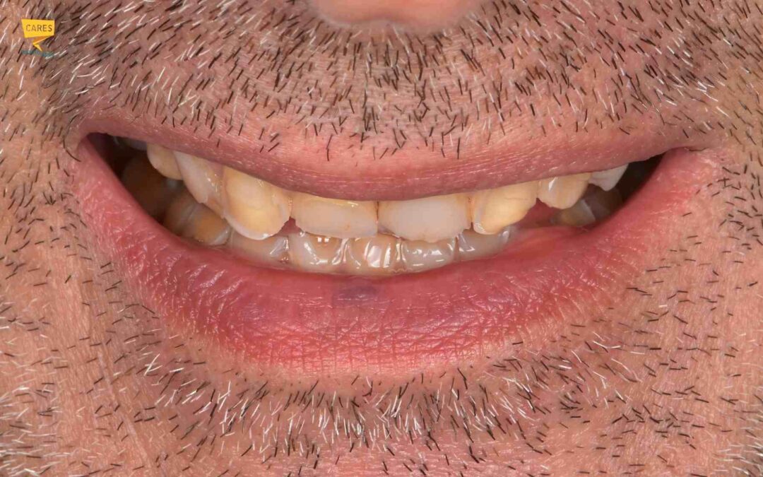 Denti consumati: come ricostruire il sorriso