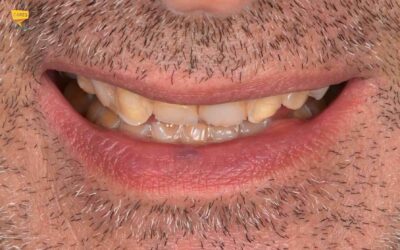 Denti consumati: come ricostruire il sorriso