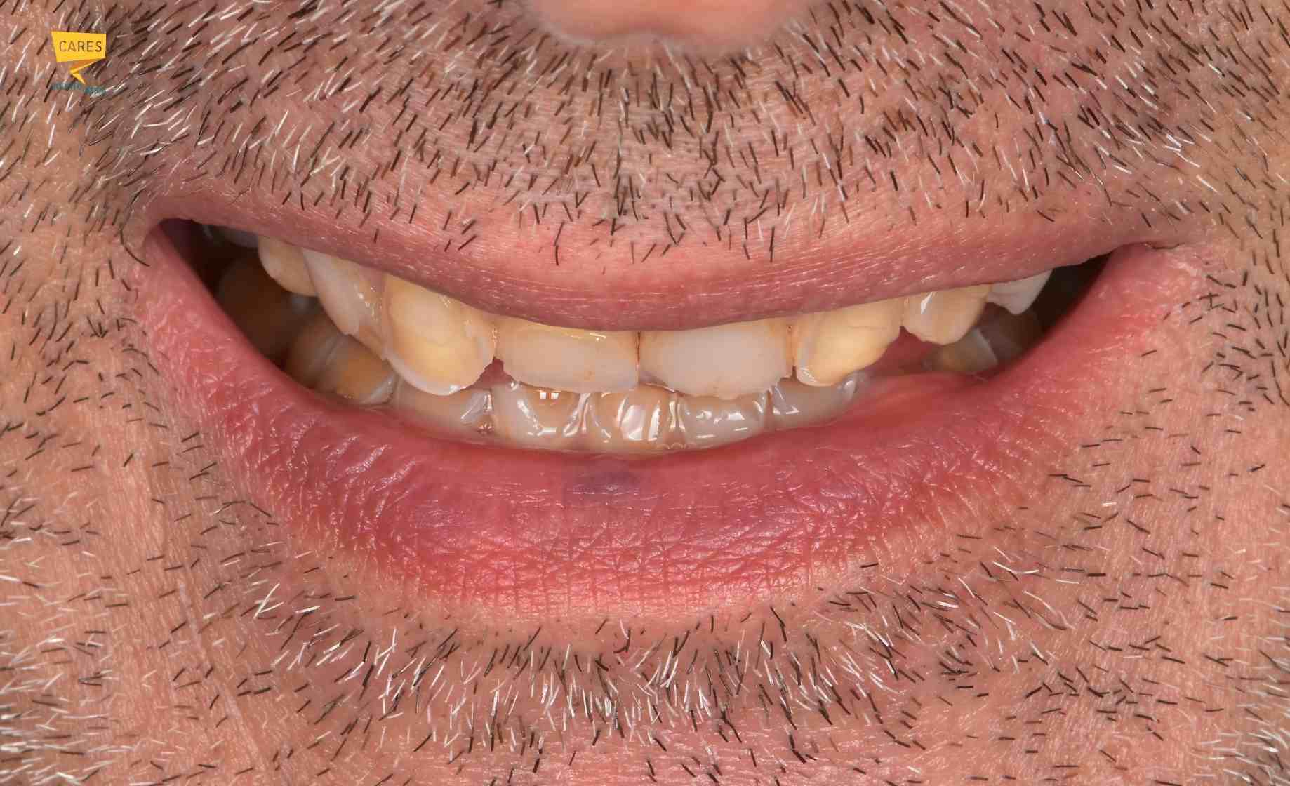 Sorriso di un paziente con denti consumati e usura dentale prima della ricostruzione estetica e funzionale.