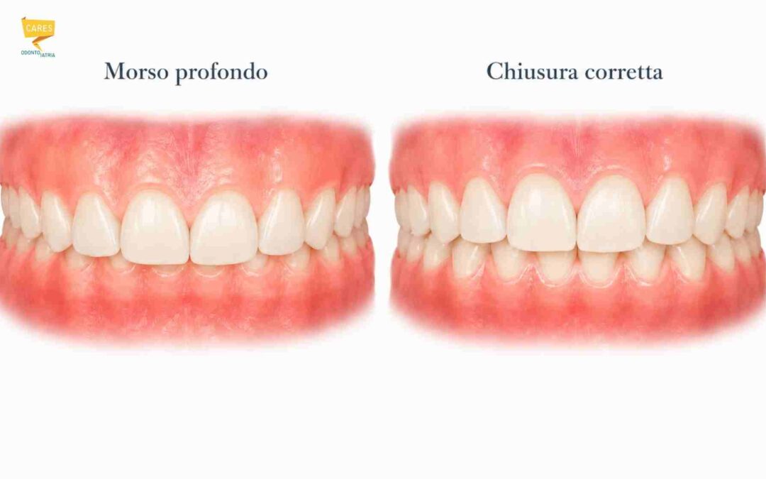 Morso profondo: diagnosi e cura bambini e adulti