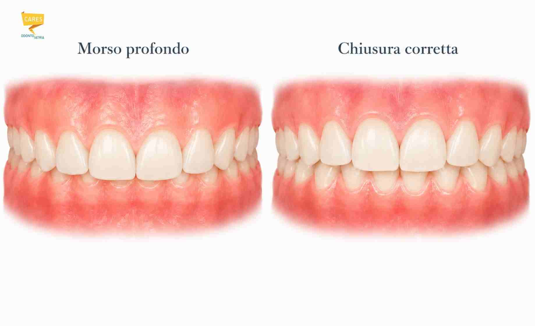 Confronto tra morso profondo e chiusura corretta, con denti superiori che coprono eccessivamente quelli inferiori.