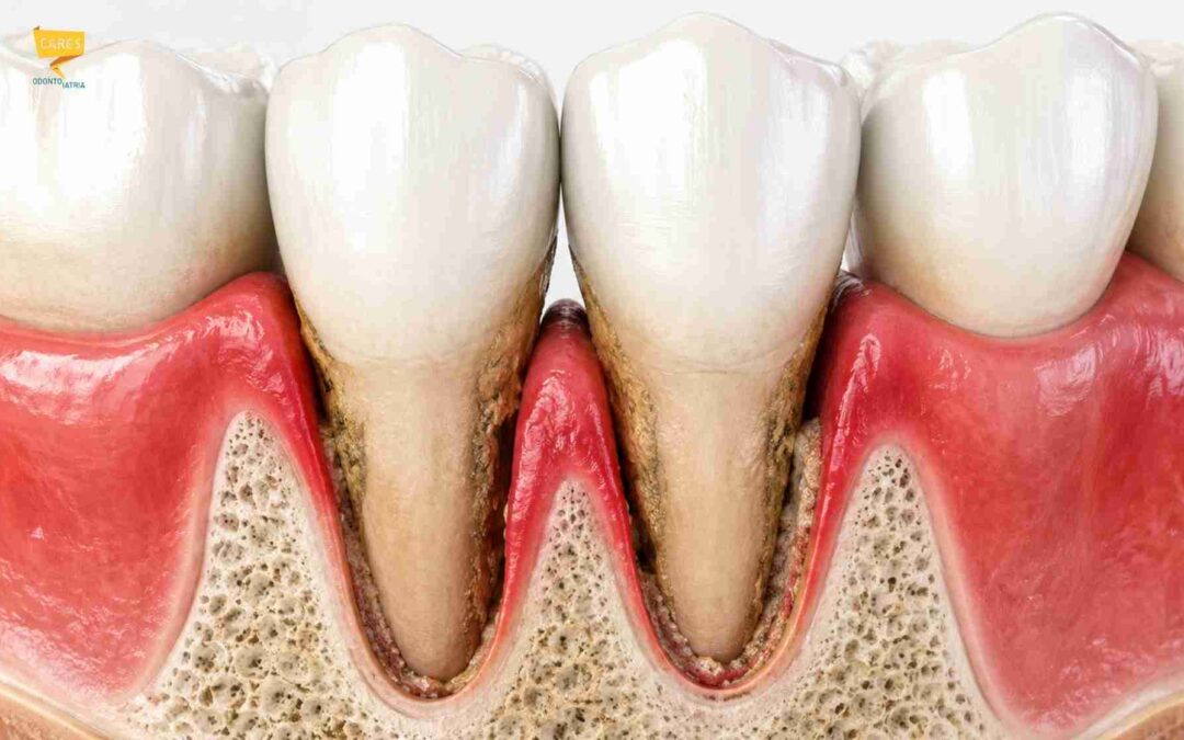 Tasche gengivali: cosa sono, cause e cura