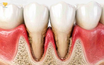 Tasche gengivali: cosa sono, cause e cura