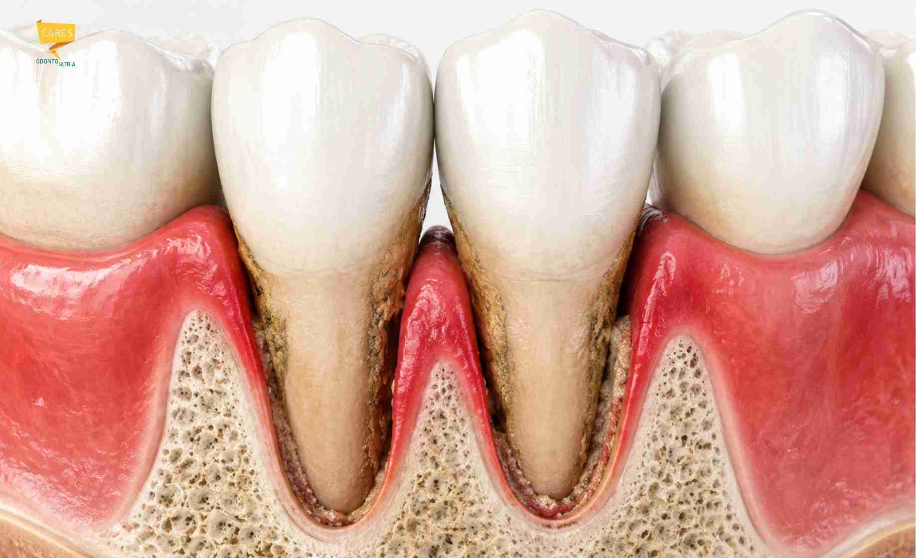 Tasche gengivali e infiammazione del parodonto Illustrazione di denti con tasche gengivali, gengive infiammate, tartaro sotto gengiva e perdita di supporto parodontale.