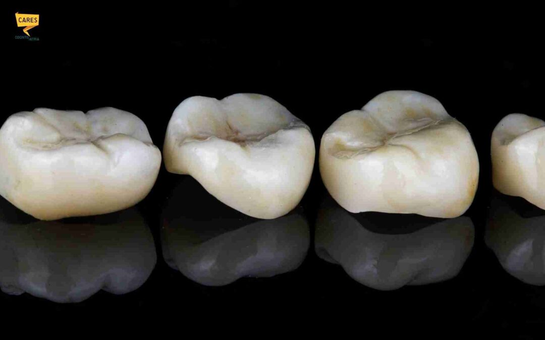 Intarsio dentale: cos’è, quando serve e quanto dura