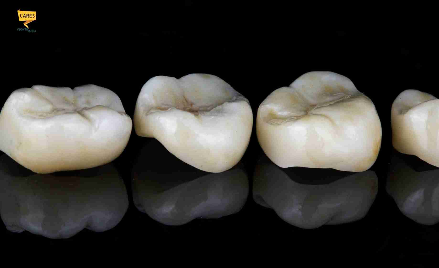 Intarsio dentale su molari posteriori per ricostruire denti danneggiati da carie o vecchie otturazioni.