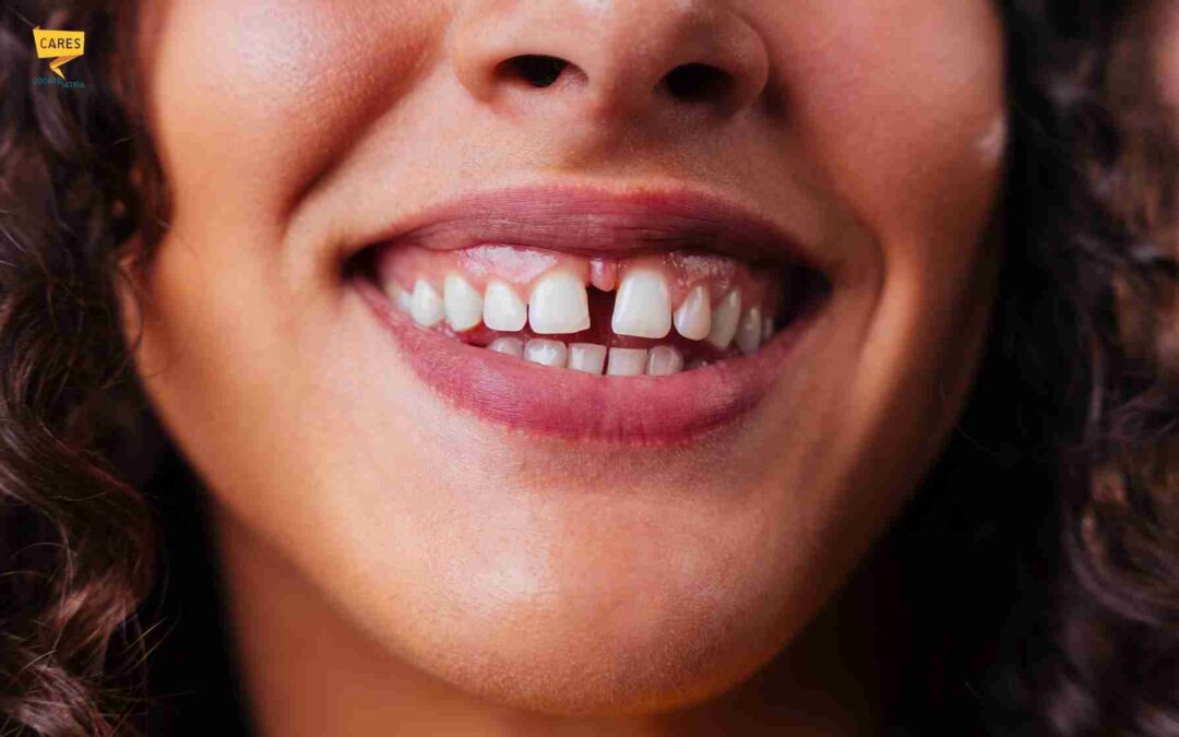 Diastema: cause, rimedi e correzione dei denti separati