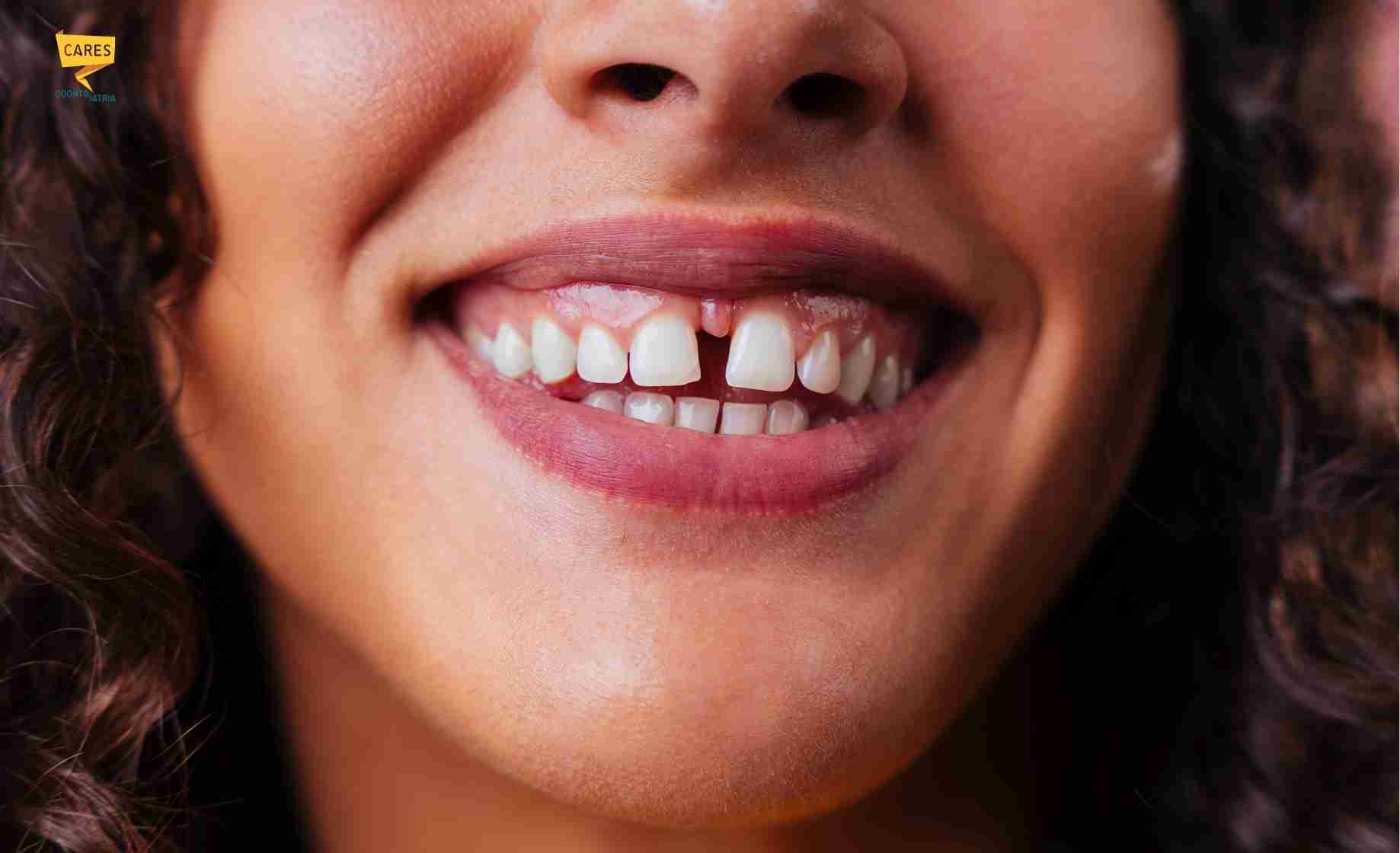 Sorriso con diastema tra gli incisivi superiori e denti separati