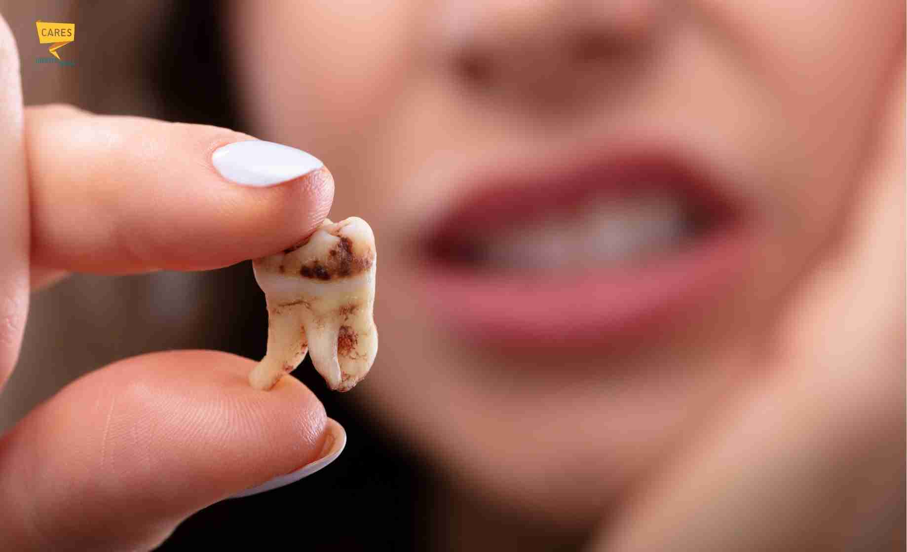 Denti cariati con macchie scure visibili Denti cariati con macchie scure visibili su un dente tenuto tra le dita, immagine esplicativa sulle cause della carie.