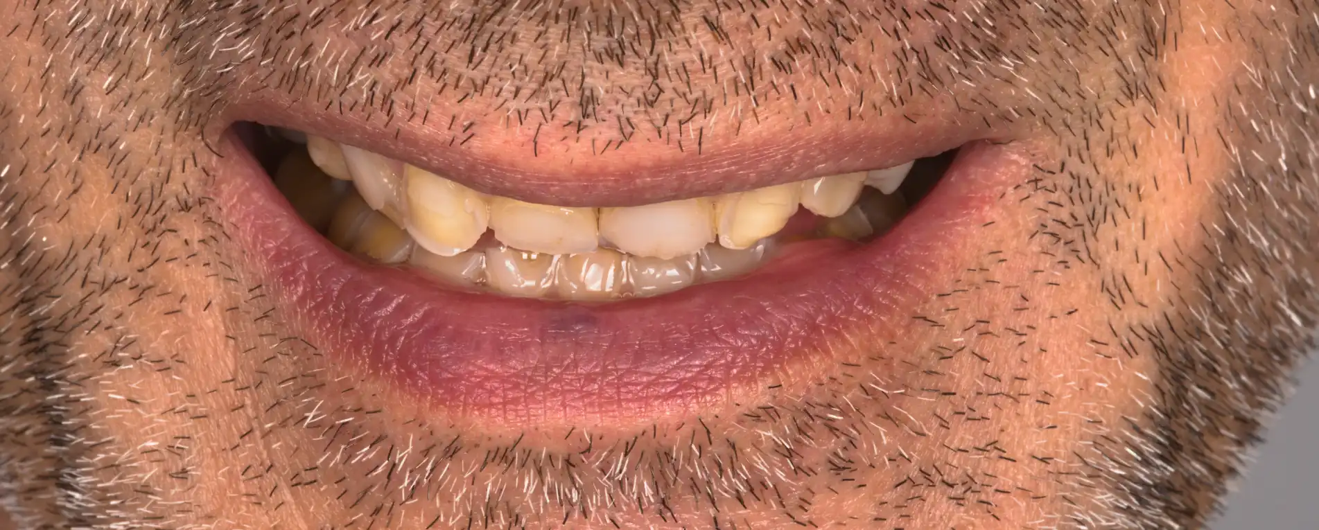 Paziente con denti consumati e usura dentale evidente prima della ricostruzione del sorriso.