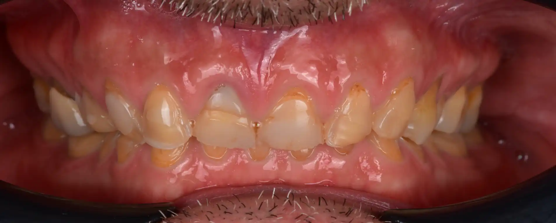 Vista intraorale di denti consumati con perdita di forma e anatomia prima della riabilitazione.
