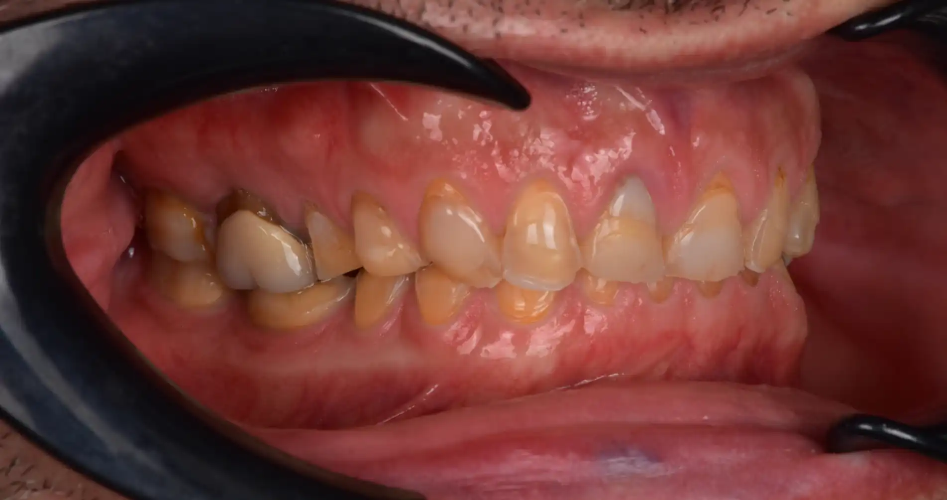 Vista laterale di denti consumati con usura dentale e perdita dell’anatomia prima della ricostruzione.