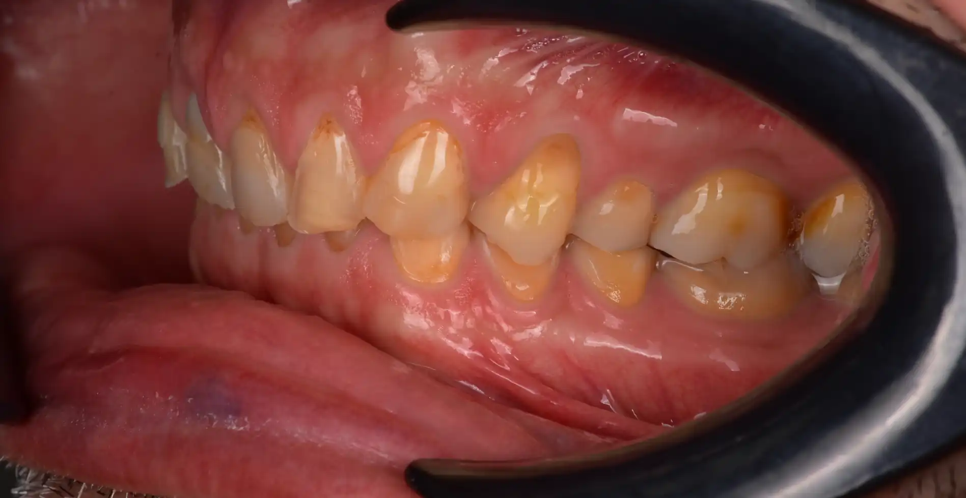 Vista laterale di denti consumati con usura evidente e perdita dell’anatomia prima del trattamento.
