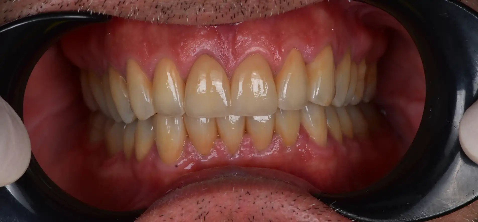 Vista frontale intraorale dopo la ricostruzione dei denti consumati e il recupero dell’anatomia dentale.