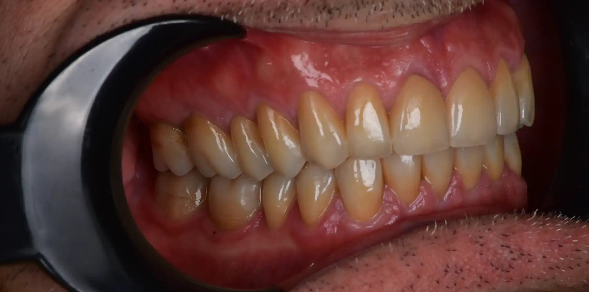 Vista laterale dopo la ricostruzione dei denti consumati con recupero di forma, volumi e anatomia.