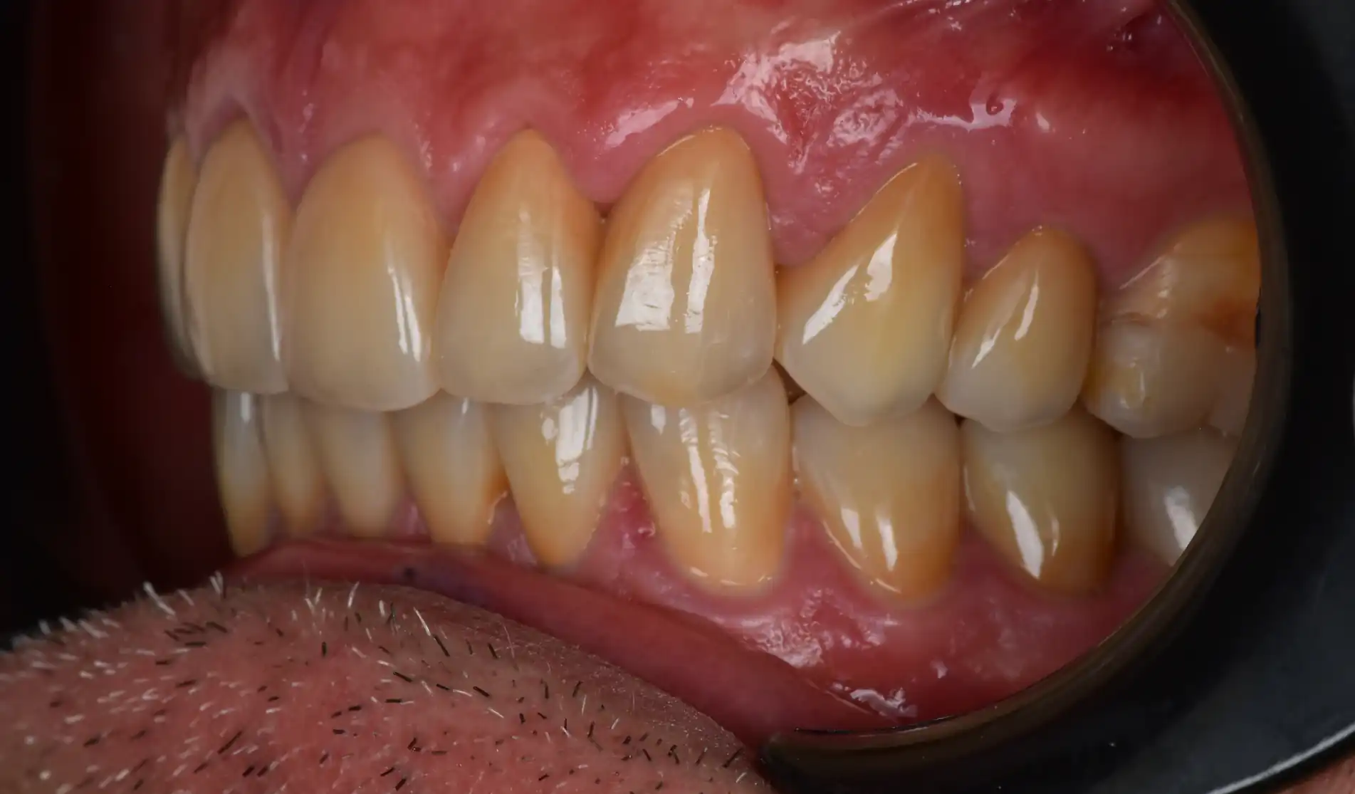 Vista laterale dopo la ricostruzione dei denti consumati con recupero dell’anatomia e dell’equilibrio del sorriso.