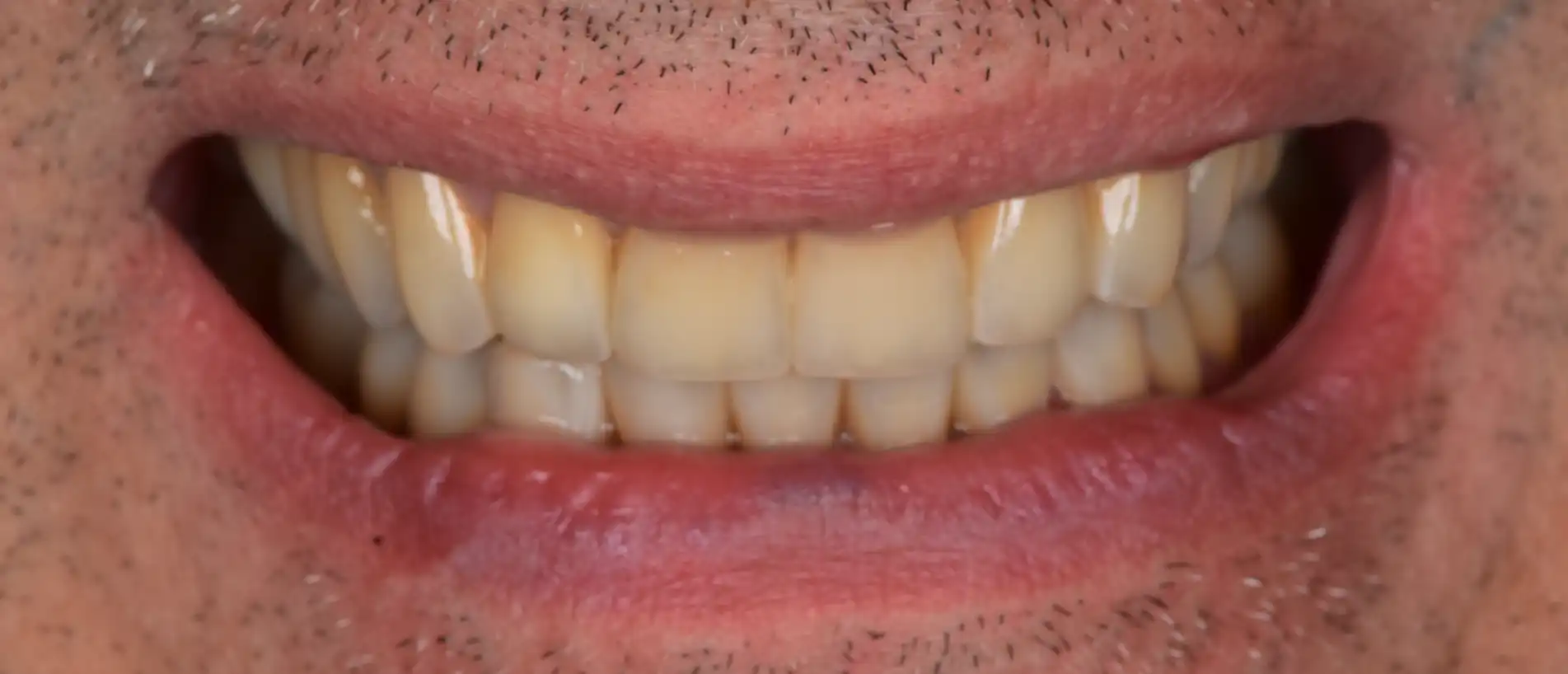 Sorriso del paziente dopo la ricostruzione dei denti consumati e il recupero dell’anatomia dentale.