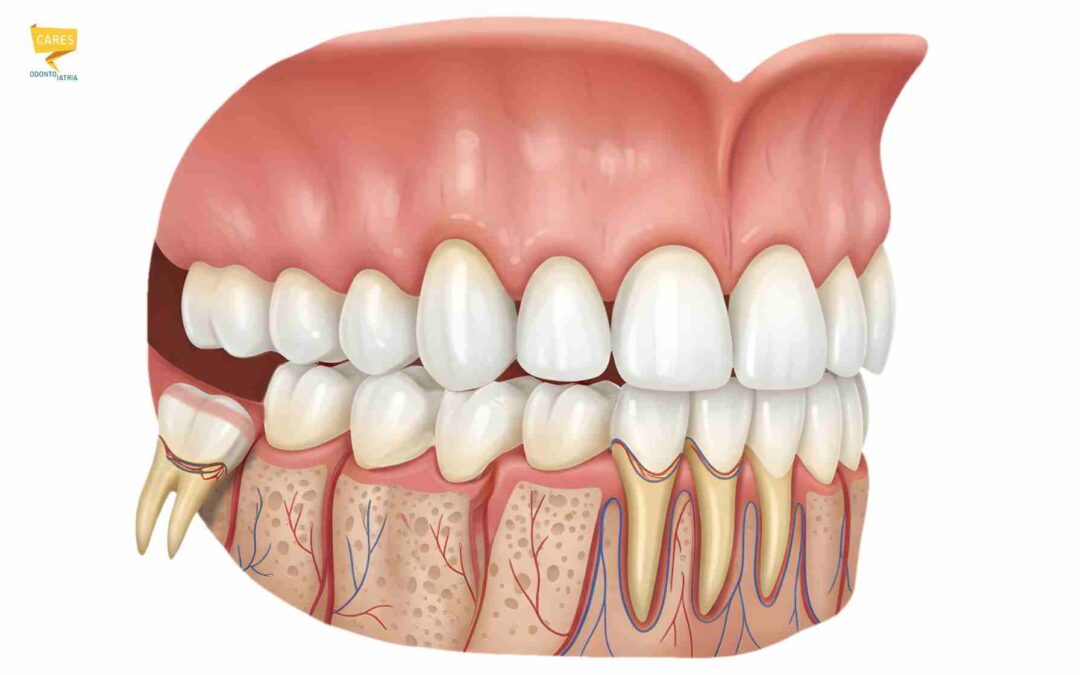 Disodontiasi: quando il dente del giudizio non riesce a uscire bene