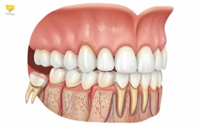 Disodontiasi: quando il dente del giudizio non riesce a uscire bene
