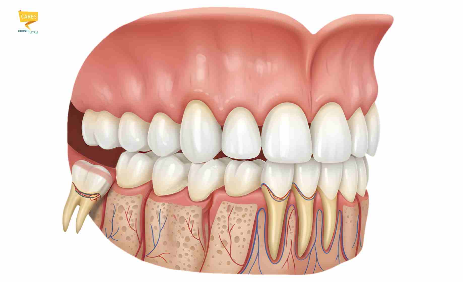 Disodontiasi del dente del giudizio incluso, con ottavo inclinato che non riesce a erompere correttamente.