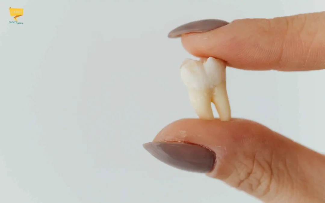 Fa male togliere il dente del giudizio? Ecco la risposta