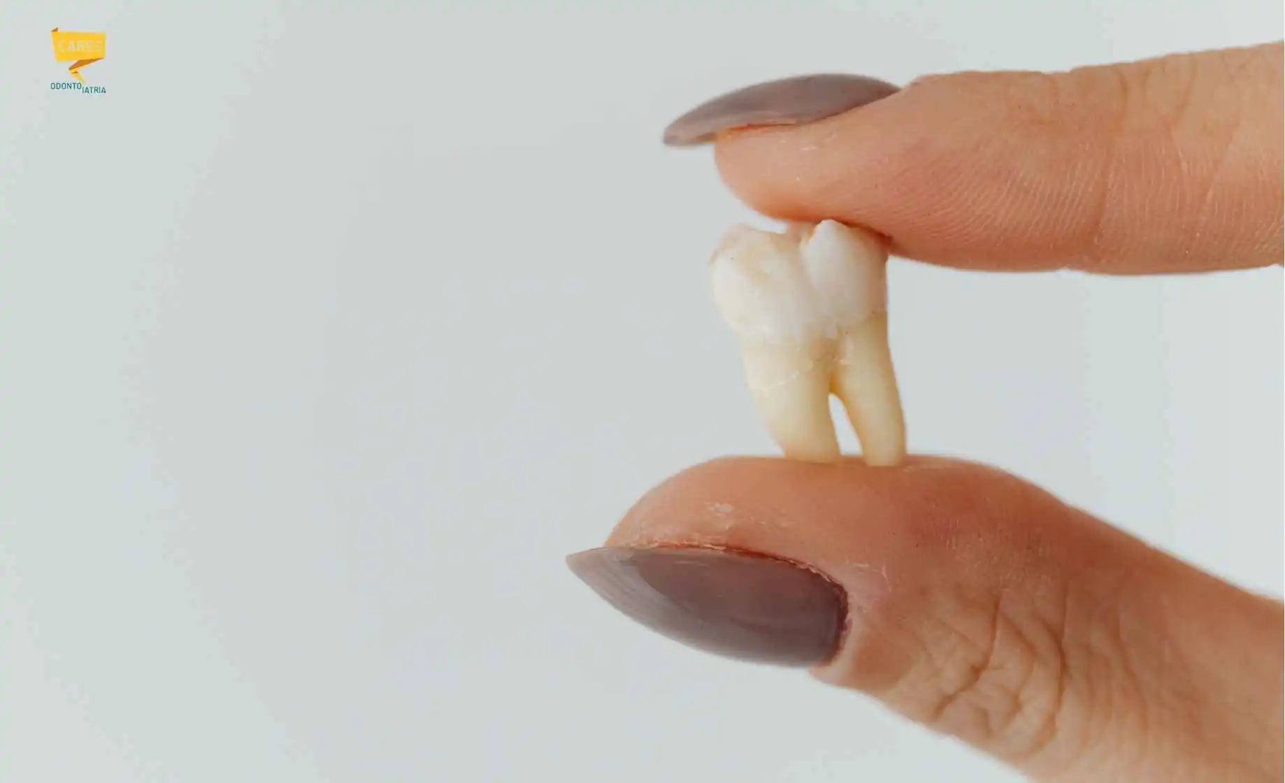 Fa male togliere il dente del giudizio? Estrazione Fa male togliere il dente del giudizio? Dente estratto dopo l’intervento