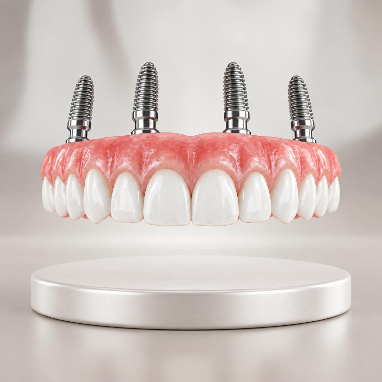 Illustrazione di una riabilitazione dentale completa con protesi fissa di un'intera arcata sostenuta da quattro impianti in titanio.