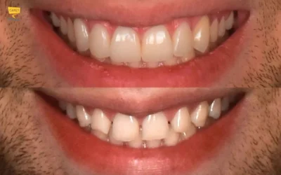 Faccette dentali prima e dopo: cosa cambia davvero