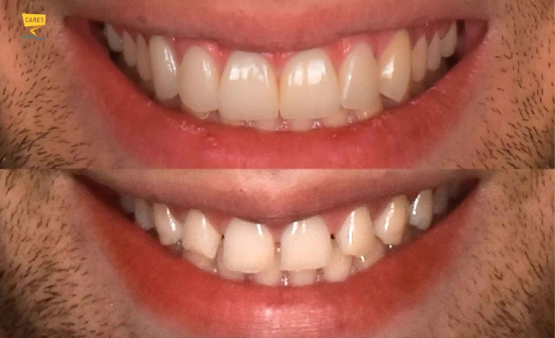 Faccette dentali prima e dopo: confronto del sorriso prima e dopo il trattamento