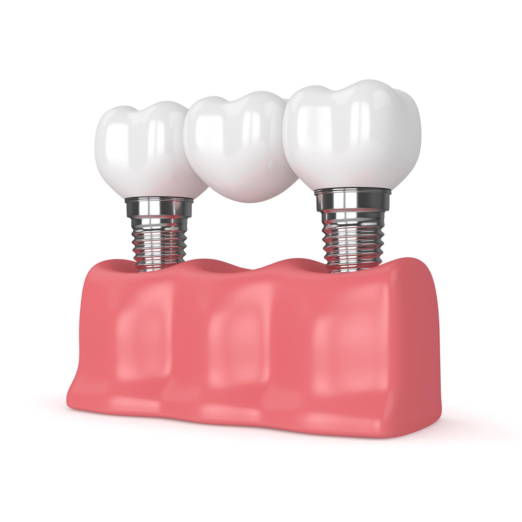 Illustrazione di un ponte dentale composto da tre corone bianche, sostenuto da due impianti dentali in titanio.