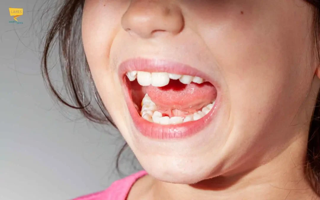 Affollamento dentale: cause, sintomi e come correggerlo