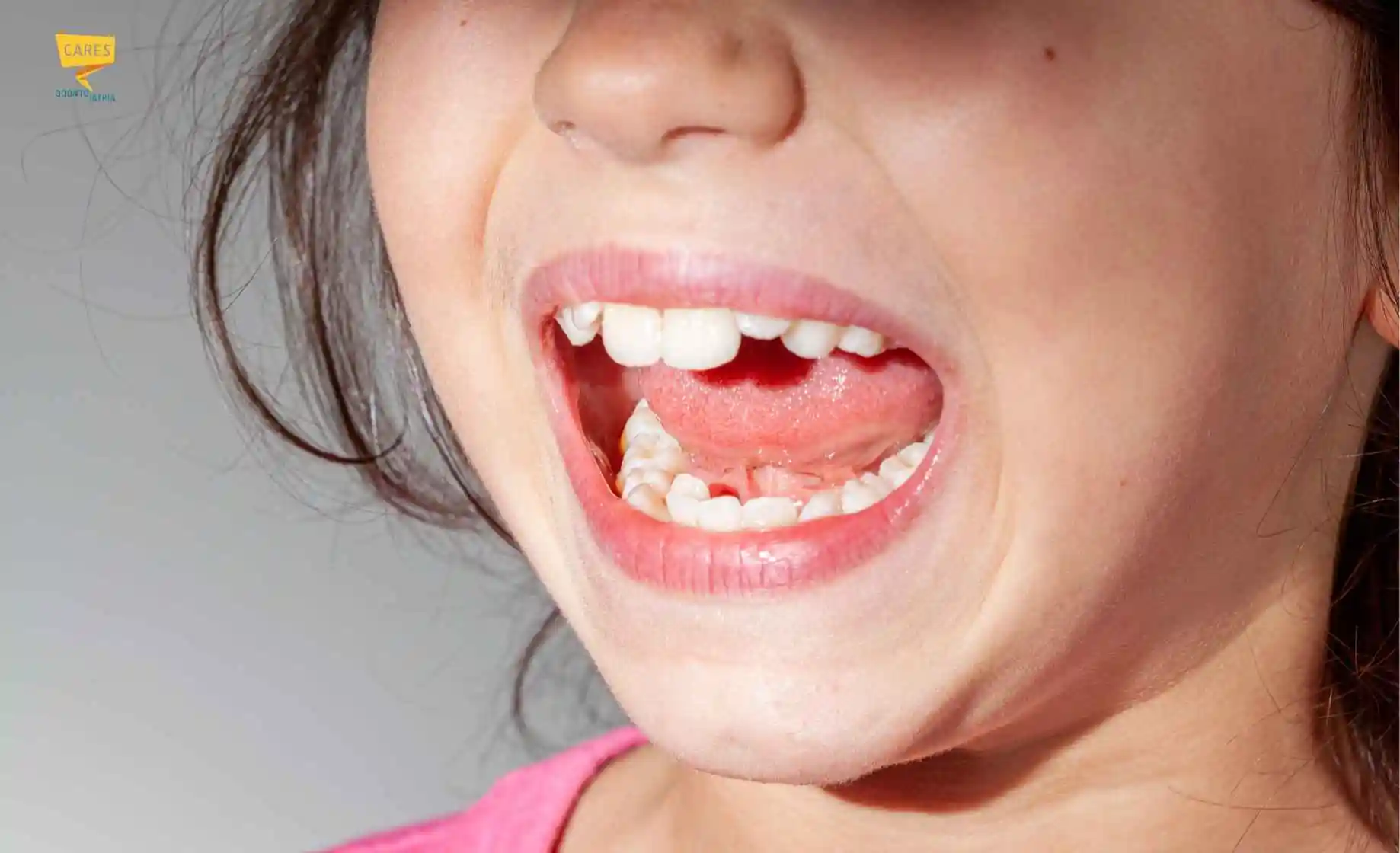 Bambina con affollamento dentale e denti permanenti in fase di eruzione