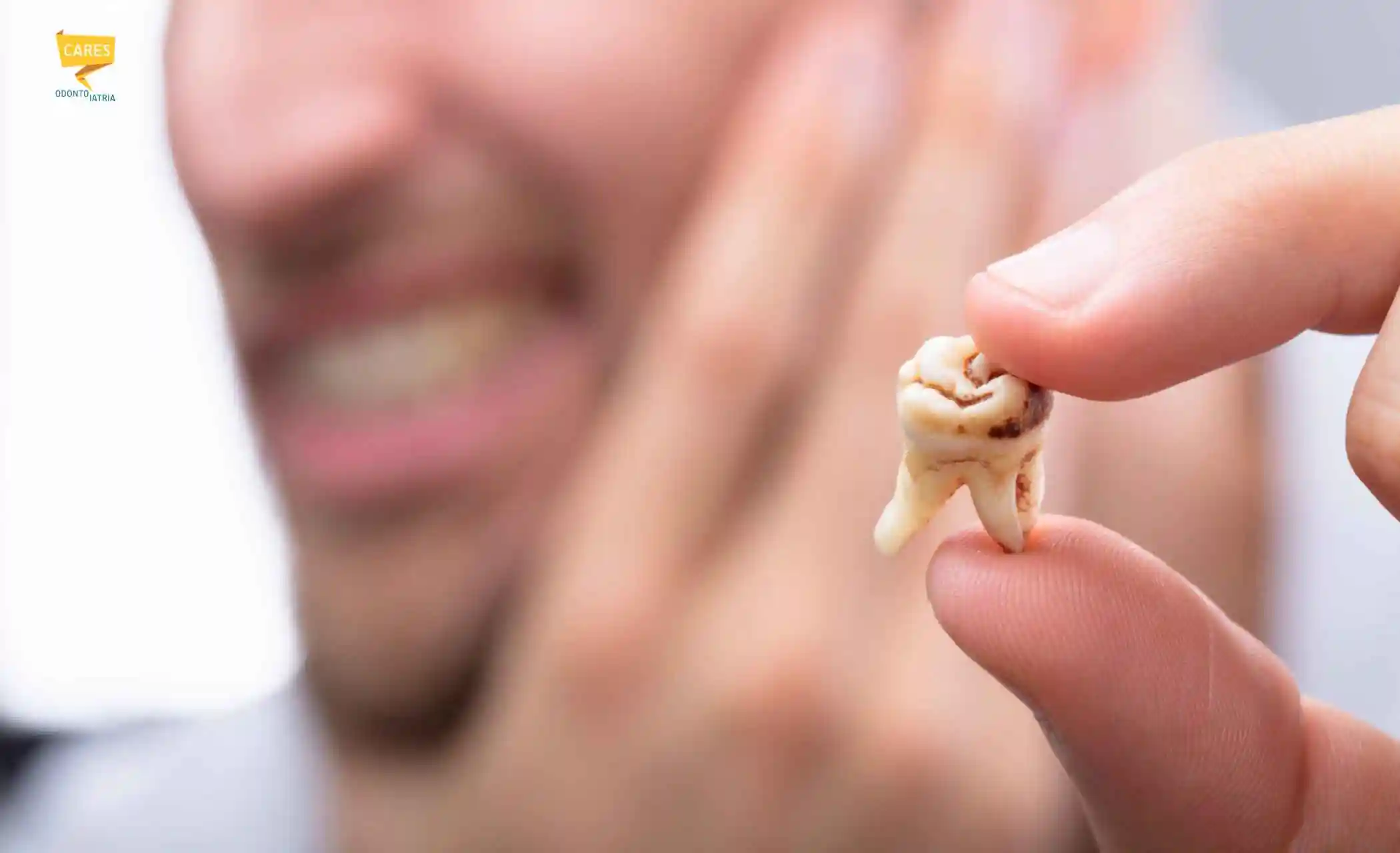Dente cariato: cosa succede se non si cura Dente cariato estratto con carie evidente