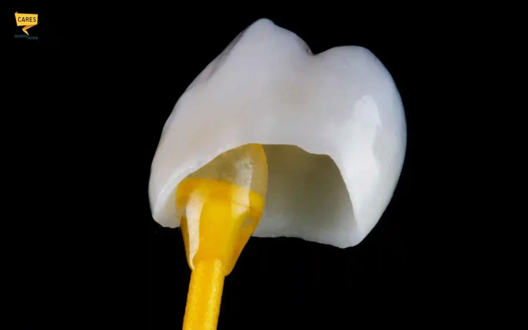 Corone dentali: cosa sono, quali scegliere e quanto durano