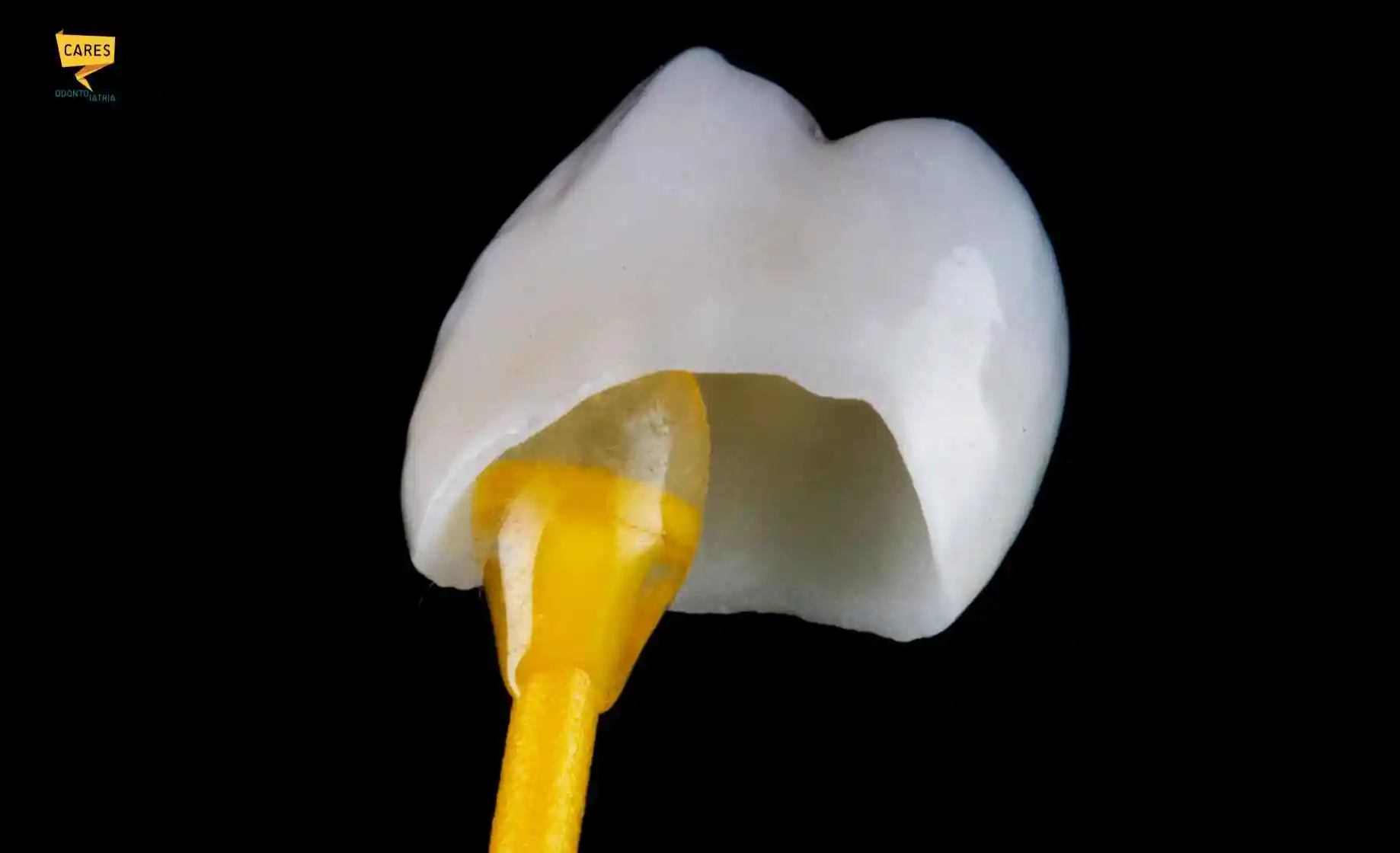 Corone dentali bianche viste dall'interno, con struttura cava e supporto giallo, esempio di protesi utilizzata per ripristinare un dente danneggiato.