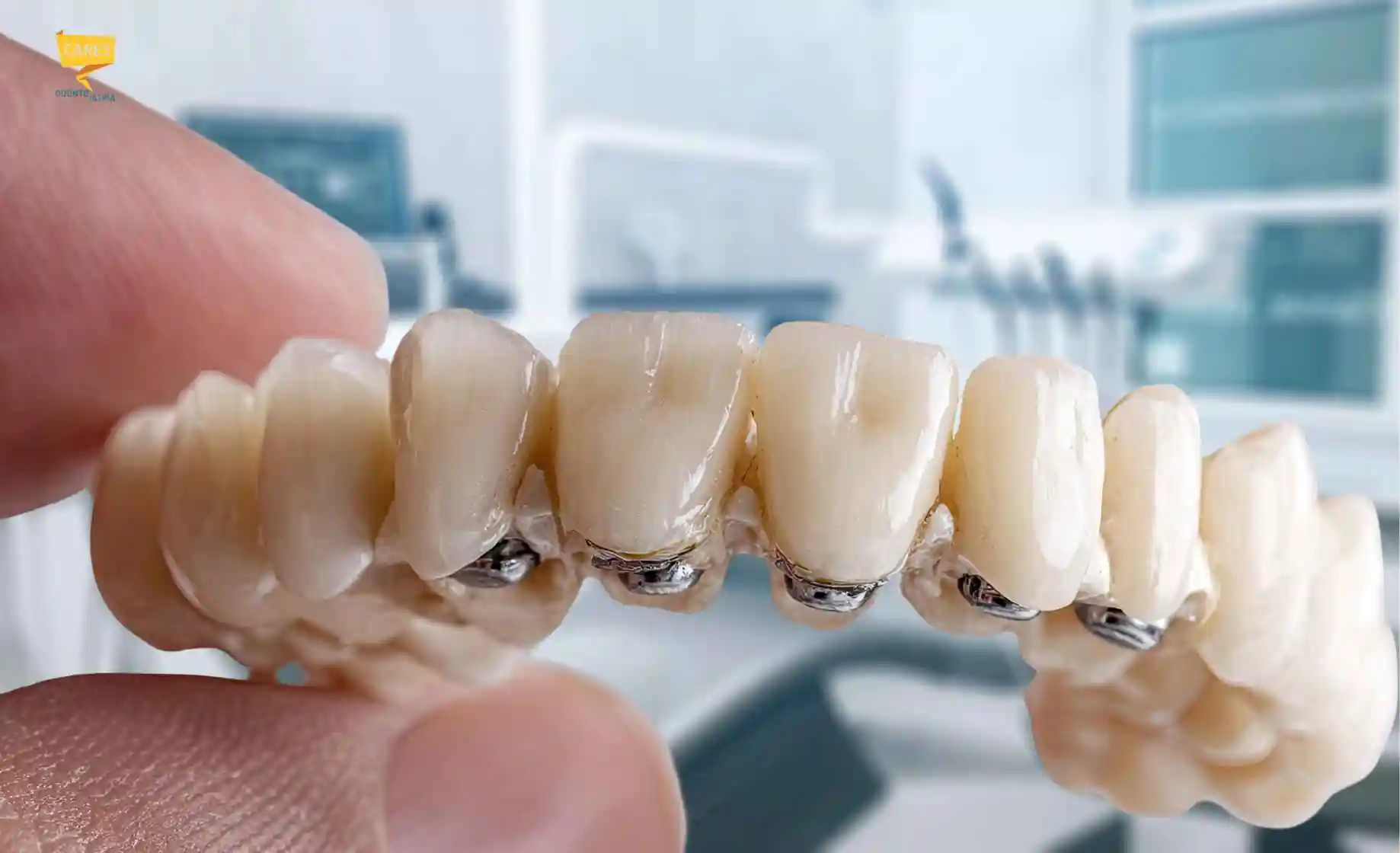Protesi dentale fissa su impianti con struttura avvitata e denti artificiali, realizzata per una riabilitazione completa dell'arcata dentale.